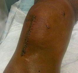 重创的伤口,揭秘重创伤口的康复历程